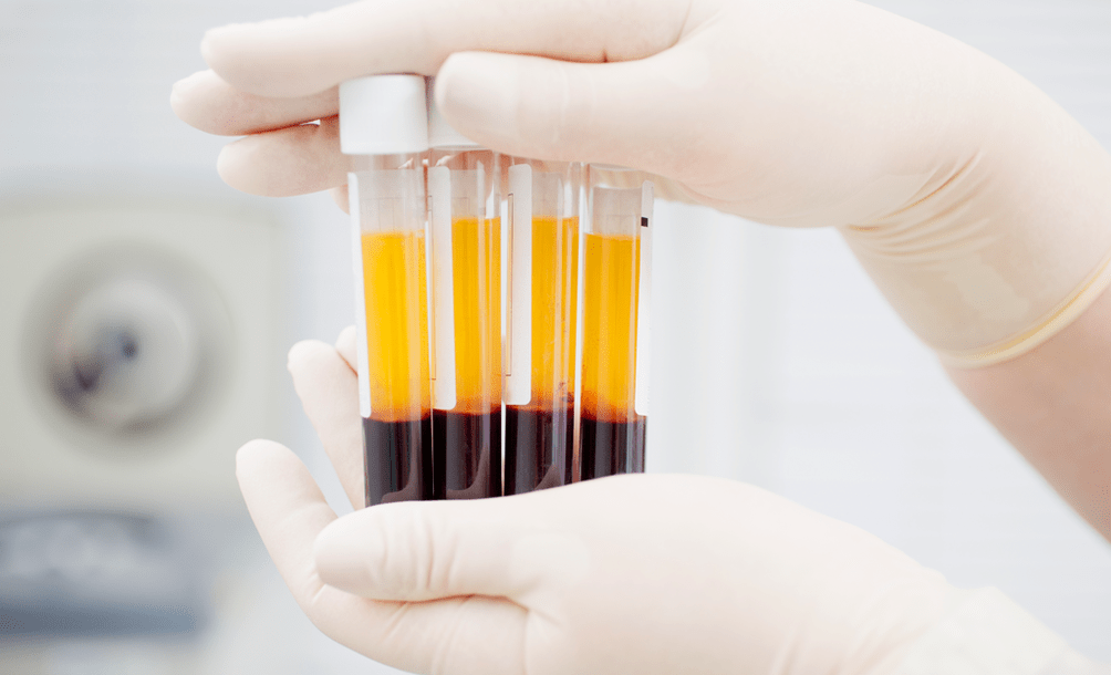 البلازما الغنية بالصفائح الدموية لعلاج PRP في هشاشة العظام